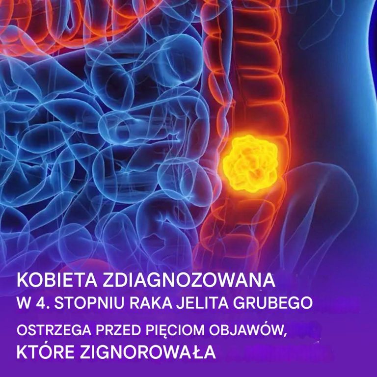 Kobieta ujawnia pięć objawów raka jelita grubego, których nie należy ignorować