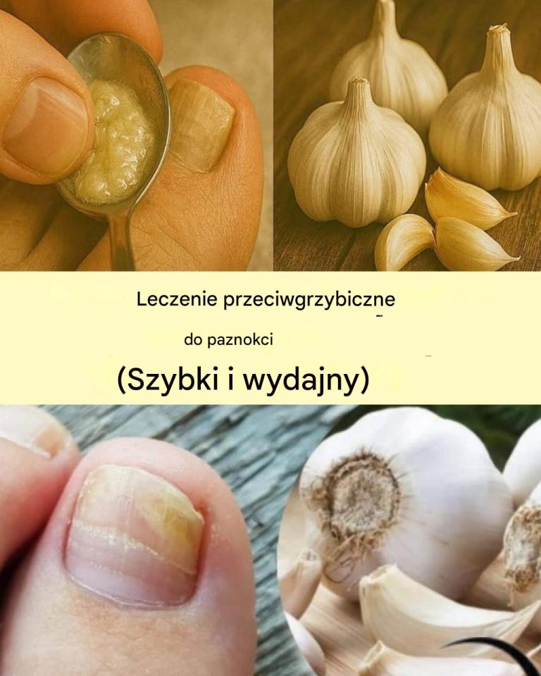 Jak można wykorzystać czosnek do walki z grzybicą paznokci?