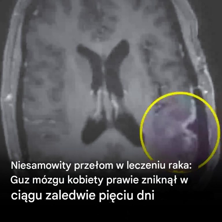 Przełom w leczeniu raka: Guz mózgu kobiety prawie zniknął w ciągu zaledwie pięciu dni