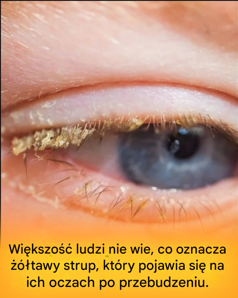 Żółty strup po przebudzeniu: co to oznacza?