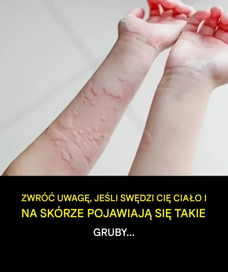 Odkryto zaskakujące przyczyny pokrzywki
