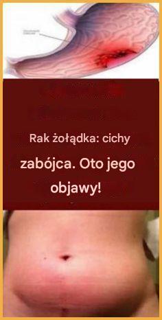RAK ŻOŁĄDKA – CICHY ZABÓJCA. Oto jego objawy!