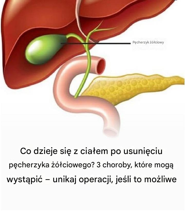 Co dzieje się z ciałem po usunięciu pęcherzyka żółciowego? 3 choroby, które mogą wystąpić – unikaj operacji, jeśli to możliwe!