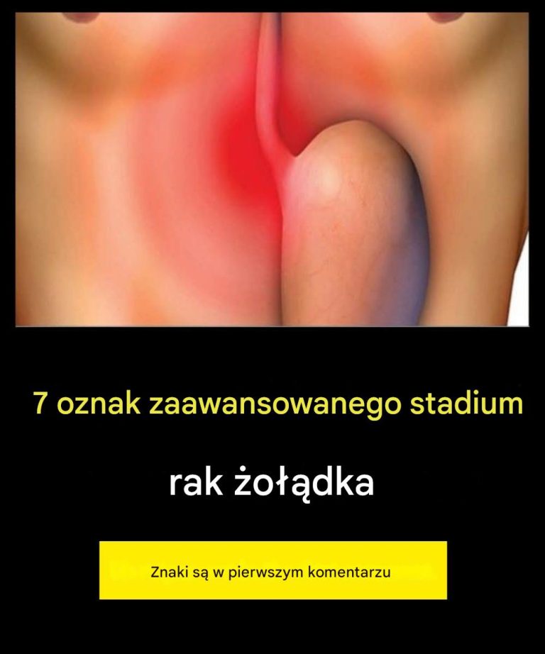7 objawów zaawansowanego raka żołądka