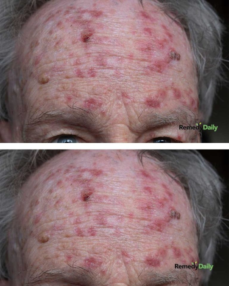 Ta czerwona, łuszcząca się plama nie znika. Mam ją na całym czole, a lekarz nie odpowiada. Co to jest?