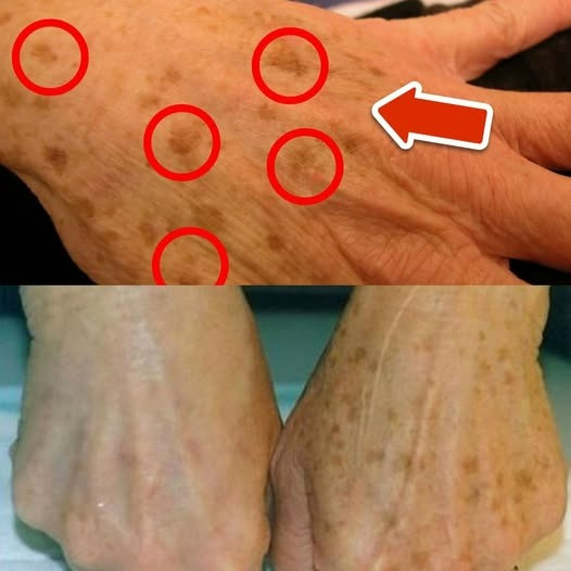 Najlepsza witamina usuwająca plamy starcze