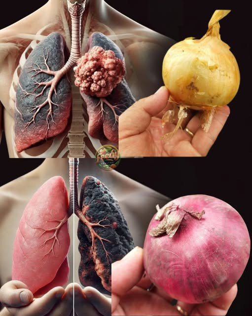 Wyczyść swoje płucaPrzestań kaszleć w trzy dni! Przepis na zapalenie oskrzeli…