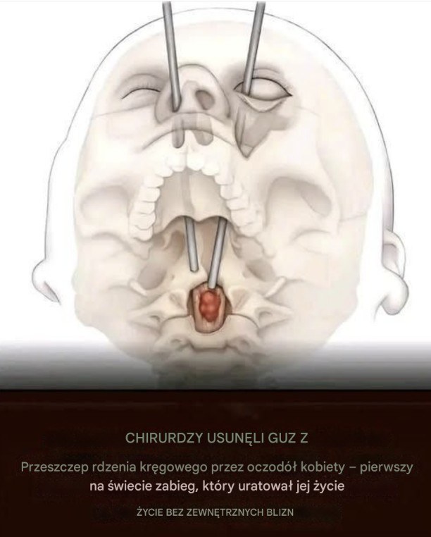 Rewolucyjna operacja usunięcia guza kręgosłupa przez oczodół