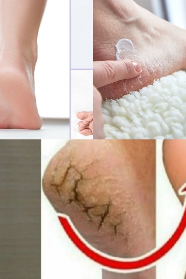 Ta naturalna sztuczka pomoże Ci uporać się z popękanymi piętami już od nocy!