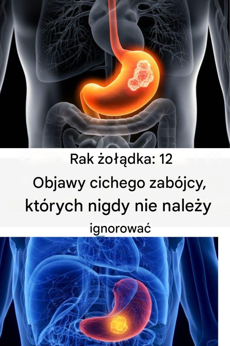 Zwróć uwagę na te 12 dyskretnych objawów raka żołądka