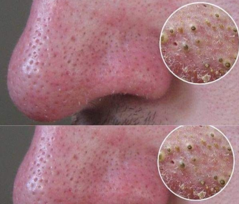 5 najskuteczniejszych sposobów na pozbycie się zaskórników w mgnieniu oka