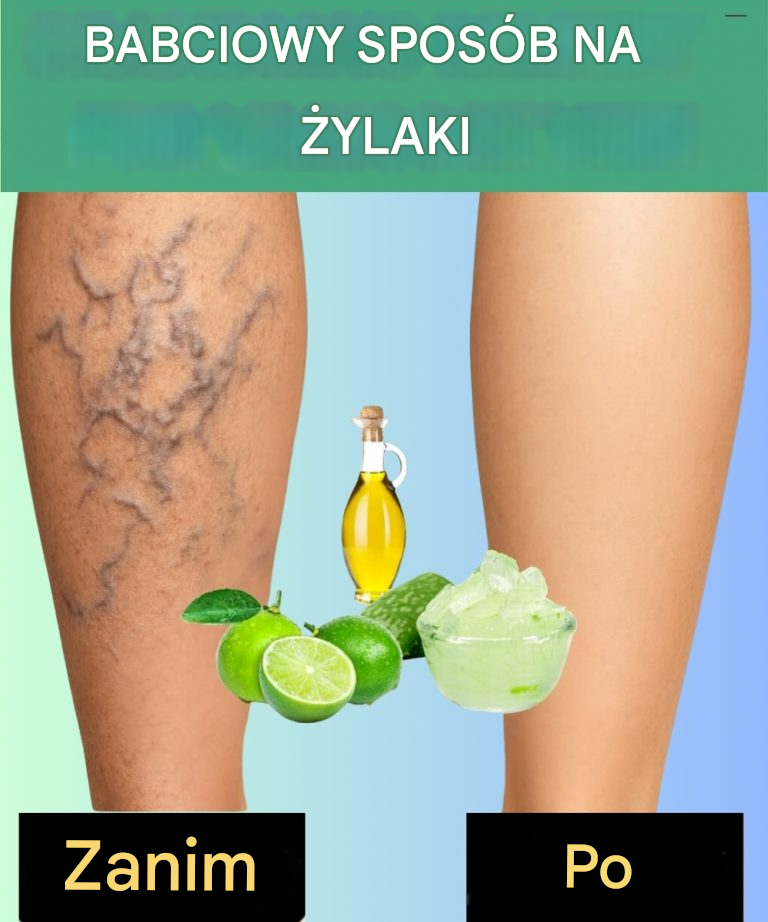 Grandma’s Remedy for Varicose Veins: Naturalna receptura z Aloe Vera, ocet jabłkowy i cytryna