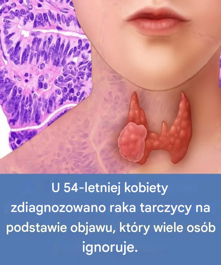 54-letnia kobieta dowiedziała się, że ma raka tarczycy, co jest objawem, na który często nie zwraca się uwagi