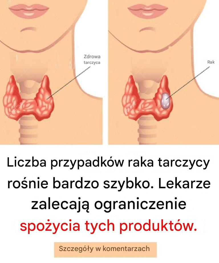 Liczba przypadków raka tarczycy gwałtownie rośnie. Lekarze zalecają ograniczenie spożycia tych produktów.