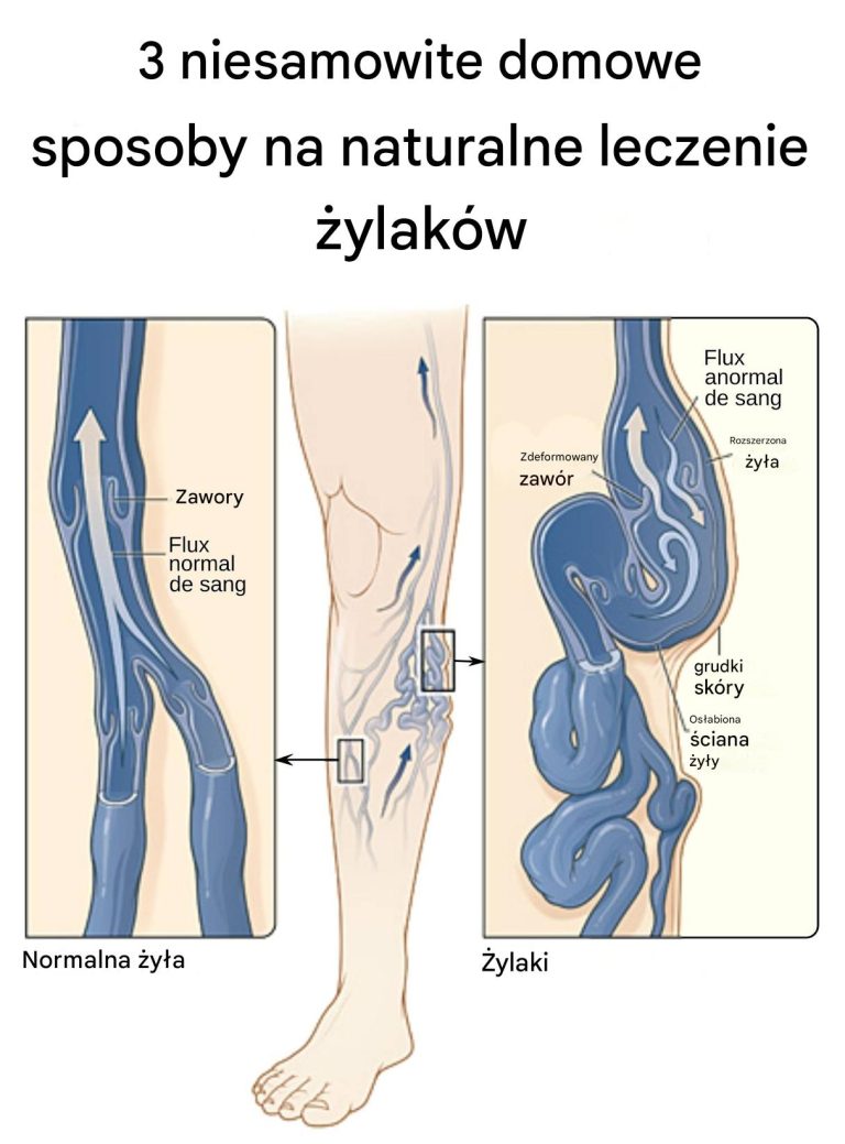 3 niesamowite domowe sposoby na naturalne leczenie żylaków