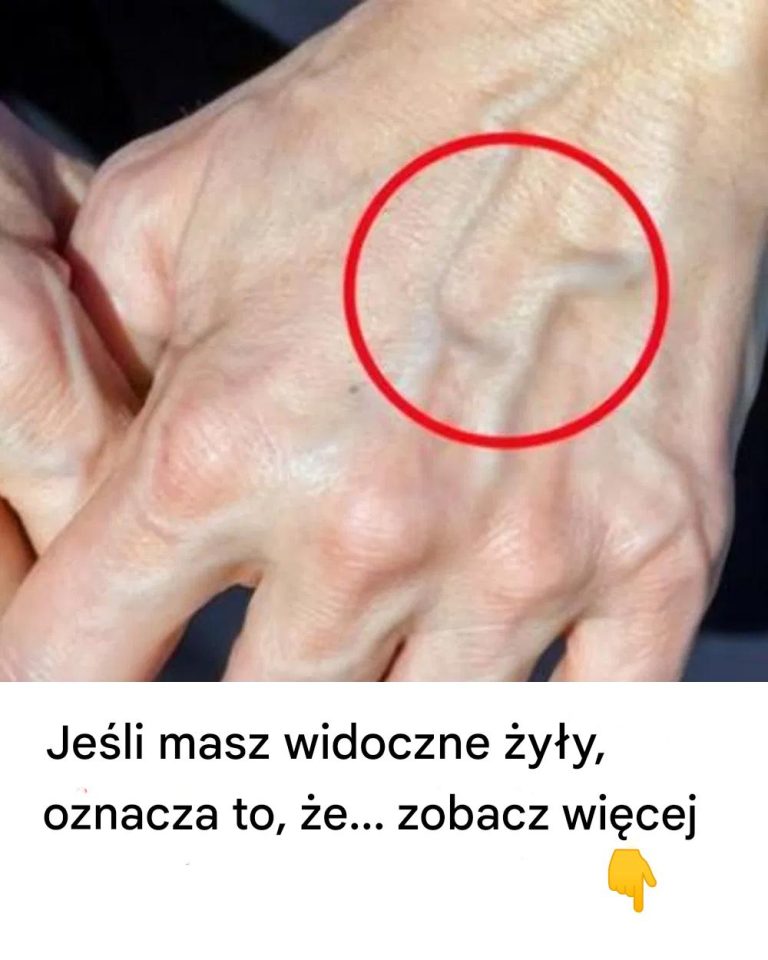 Kiedy należy martwić się nagłym pojawieniem się widocznych żył