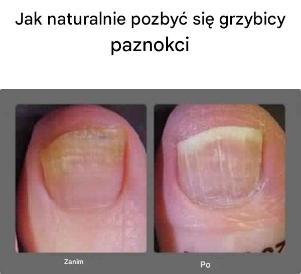 Jak naturalnie pozbyć się grzybicy paznokci