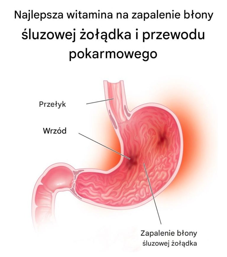 Witamina U: idealna w przypadku zapalenia błony śluzowej żołądka i przewodu pokarmowego?