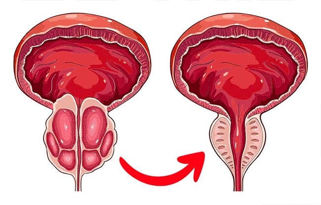 Żywność, która zmniejsza przerost prostaty