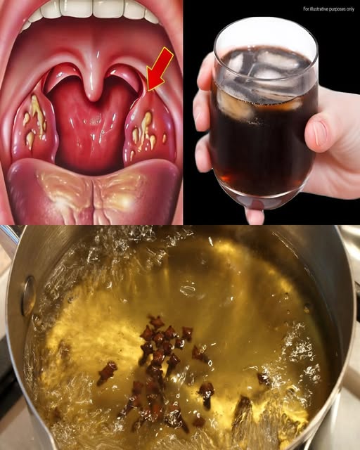 Łagodzi ból gardła i stany zapalne. Naturalny antybiotyk!